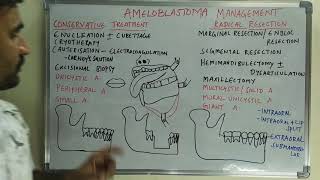 Ameloblastoma management [upl. by Klemens946]