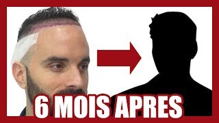 CALVITIE  MA GREFFE DE CHEVEUX  6 MOIS APRÈS [upl. by Delacourt536]