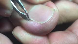 Ingrown Toenail Removal [upl. by Davy]