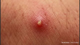 So satisfying blackheads whiteheads and pimples removal 4 pimpleremedies blackheadsolutions [upl. by Perr]