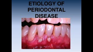 Etiology of Periodontal disease part 1 [upl. by Annaegroeg]