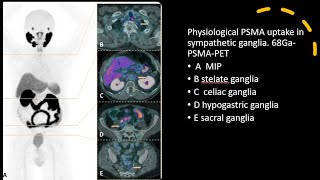 PSMA PET CT procedure guideline for prostate cancer MCQS SCFHS PETCT nuclearmedicineMCQ frcr [upl. by Brig]