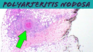 Polyarteritis Nodosa vasculitis pathology dermpath dermatology usmle dermatopathology [upl. by Killen37]