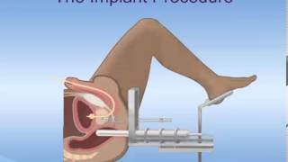 Brachytherapy for Prostate Cancer [upl. by Candie]