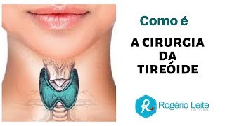 Tireoide Como É A Cirurgia Da Tireoide [upl. by Enixam]