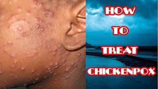 Chickenpox Treatment  How To Treat Chickenpox  Lifestyle amp Home Remedies [upl. by Richel]