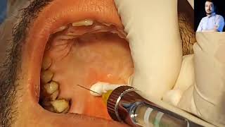 Local Anesthesia Greater Palatine Nerve Block Technique Maxillary anesthesia Techniques dentistry [upl. by Tabina426]