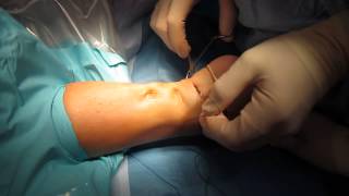 Percutaneous Achilles Tendon Surgery Repair Unedited by Kevin R Stone MD [upl. by Lamrouex]