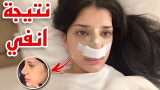 اخيرا نتيجة انفي بعد عملية التجميل 👃🏻 [upl. by Attikram]