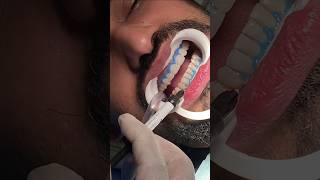 Teeth Whitening Procedure 😱🫣drrehanahmed dentistavenue teethwhitening teethwhitening teethcare [upl. by Brandice]