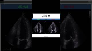 EF 4930  eyeball estimation visual EF ejection fraction echocardiography [upl. by Carleton]