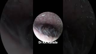 Alive Black Flying Insect Removal From Ear doctor entspecialist shortvideo shorts [upl. by Trebled]