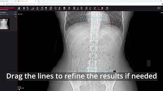 MedDream DICOM Viewer measure the Cobb angle [upl. by Shargel]