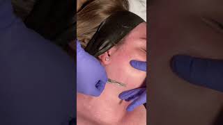 Dermaplane  Satisfying Peach Fuzz Removal  Ashley Aesthetics [upl. by Thursby]