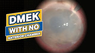 DMEK with NO Anterior Chamber [upl. by Eiramanel962]