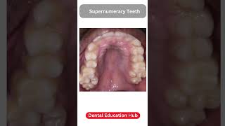 Supernumerary Teeth  Paramolar [upl. by Eartha]