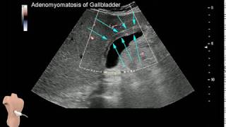 Adenomyomatosis of the Gallbladder [upl. by Lesser483]