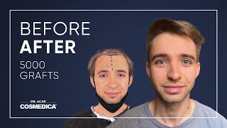 Hair Transplant in Turkey  Hair Transplant Results of Cosmedica [upl. by Fiden998]