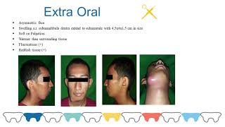 MANAGEMENT OF ABSCESS IN PATIENT WITH ODONTOGENIC INFECTIONS [upl. by Lyram]