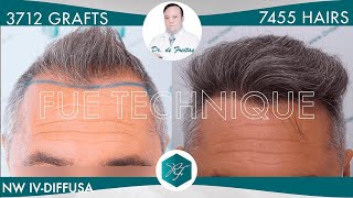 Hair Graft Technique FUE  3712 Grafts 7455 Hairs  Dr Rafael de Freitas [upl. by Aciretehs]