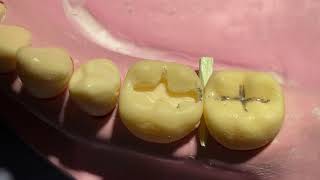 Class II cavity preparation [upl. by Oiramal]