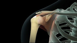 Rotator Cuff Shoulder Surgery [upl. by Felske]