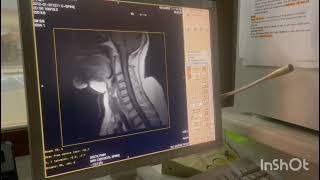 How to perform MRI Cervical spine on open MRI Hitachi machine Planning MRI Cervical spine open MRI [upl. by Eerpud220]