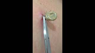 Tick removal by US doctor [upl. by Rramo]