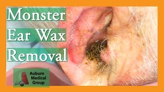 Monster Ear Wax Removal Brings New Life to JOKESTER Patient  Auburn Medical Group [upl. by Otreblaug]