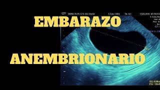 EMBARAZO ANEMBRIONARIO Diagnóstico y tratamiento [upl. by Enilrae]