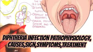 Diphtheria Infection Pathophysiology CausesSignSymptomsTreatment [upl. by Shaylah]