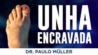 Unha Encravada O Que Fazer – Dr Paulo Müller Dermatologista [upl. by Noerb]