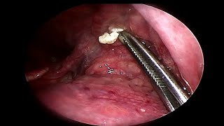 Removing LARGE Tonsil Stone  Doctor Anh [upl. by Ravo880]