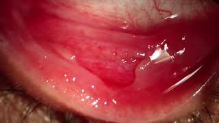 Pseudomembranes removal in Epidemic Keratoconjunctivitis [upl. by Bowler]