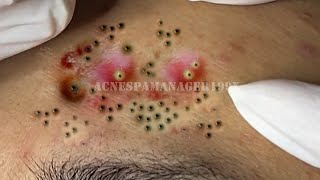 Extreme Blackhead Removal at LNG Skin Care 7221 [upl. by Anaej]