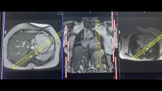 Planning of 2CH VIEW cardiacMRI [upl. by Leahcin]