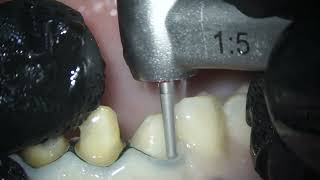 Preparation of teeth for ceramic crowns and veneers toothdental dentistry dental dentist [upl. by Codding313]