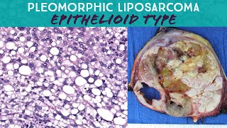 Pleomorphic liposarcoma epithelioid type Oregon Case 15 pathology sarcoma spindle cell neoplasm [upl. by Egdirdle]