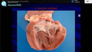 Patologia do Sistema Cardiovascular  Parte VI [upl. by Eylatan]