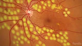 Diabetic Retinopathy Panretinal Photocoagulation [upl. by Llerraj230]