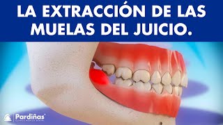 Extracción de muelas del juicio y pericoronatis  ¿Por qué se extraen las cordales © [upl. by Noraf]