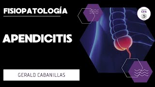 APENDICITIS  GERALD CABANILLAS [upl. by Lalad]