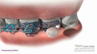 Wax Placement  Orthodontic Treatment [upl. by Nerin]