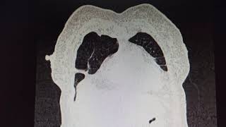 Multiple cavitary lesions with surrounding consolidation and ground glass opacification in left lung [upl. by Nrubyar]