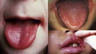 Angular Cheilitis Treatment  How to Get Rid of Angular Cheilitis in 24 hours [upl. by Sclater]