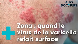 Toutes vos questions sur le zona  Allo Docteurs [upl. by Charissa]