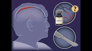 Middle Meningeal Artery Embolization for Subdural Hematoma  NEJM [upl. by Yatnoj]