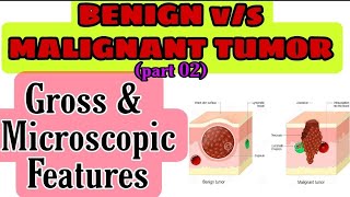 BENIGN vs MALIGNANT TUMOR on the basis of Gross amp Microscopic features  part 02 [upl. by Nerua]