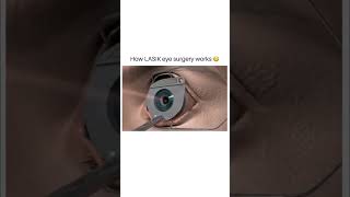 Lasik eye surgery 3dshortssurgery [upl. by Ettelohcin]