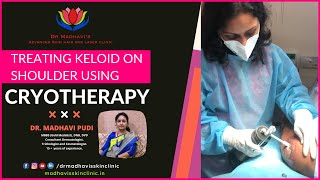 Keloids Treatment on Shoulder with Cryotherapy  Painless Cryotherapy Treatment  Dr Madhavi Pudi [upl. by Hewet]